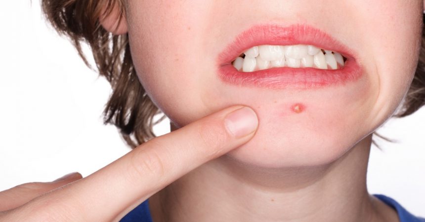 Wie Wird Die Akne Geheilt Alltagliche Pflege Der Akne Haut